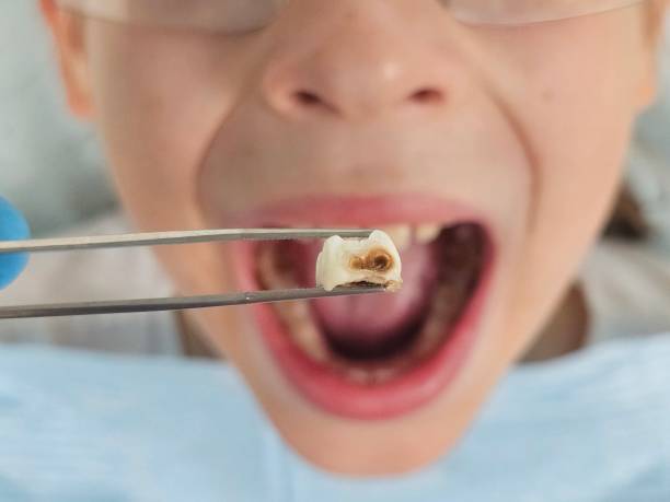 Best Emergency Dental Care for Sports Injuries in Syracuse, KS